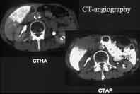 CT-angiography (CTHA CTAP)