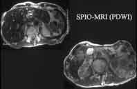 SPIO-MRI(PDWI)