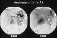 Angiography (celiacA)
