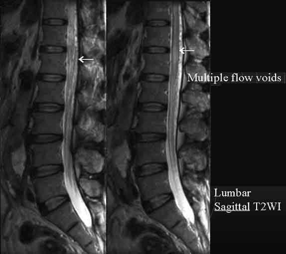 Multiple flow voids@Lumbar Sagittal T2WI