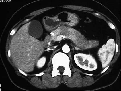 Enhanced CT; early phase