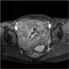 MRI (axial)/Gd-T1WI(fat-sat)