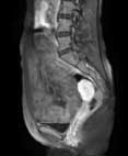 MRI (sagittal)/Gd-T1WI (fat-sat)