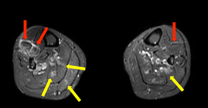 壊死性血管炎の患者の今後の見通しはどうなりますか?